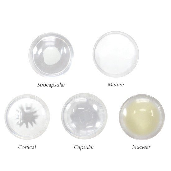 Cataract Eye (cut-away)