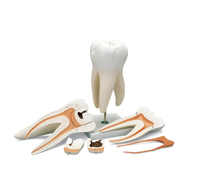 Giant Molar with Dental Cavities Human Tooth Model, 15 times Life-Size, 6 part