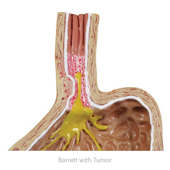 4-Piece GERD (Gastroesphageal Reflux Disease)