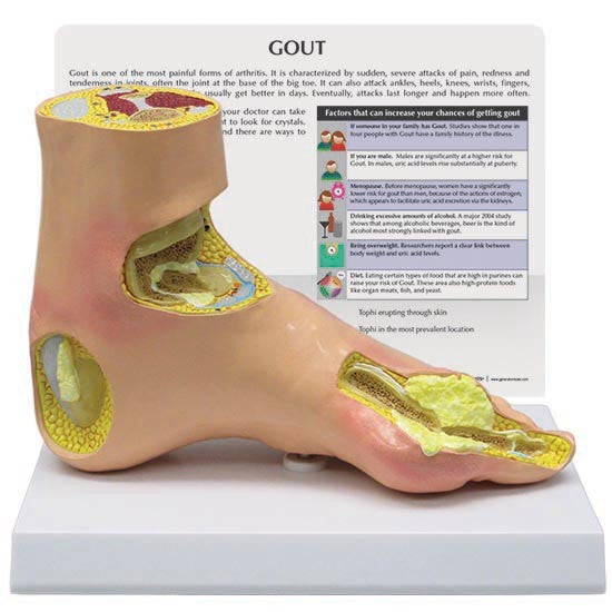 Gout (Foot)