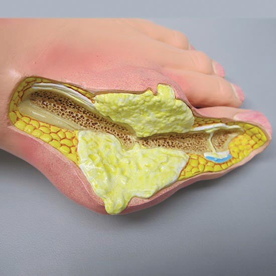 Gout (Foot)