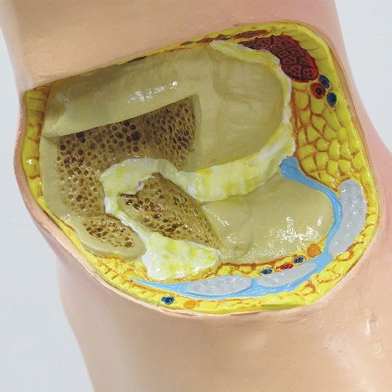 Gout (Foot)