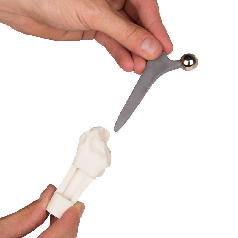 Hip Implant Comparison Set - removable implant