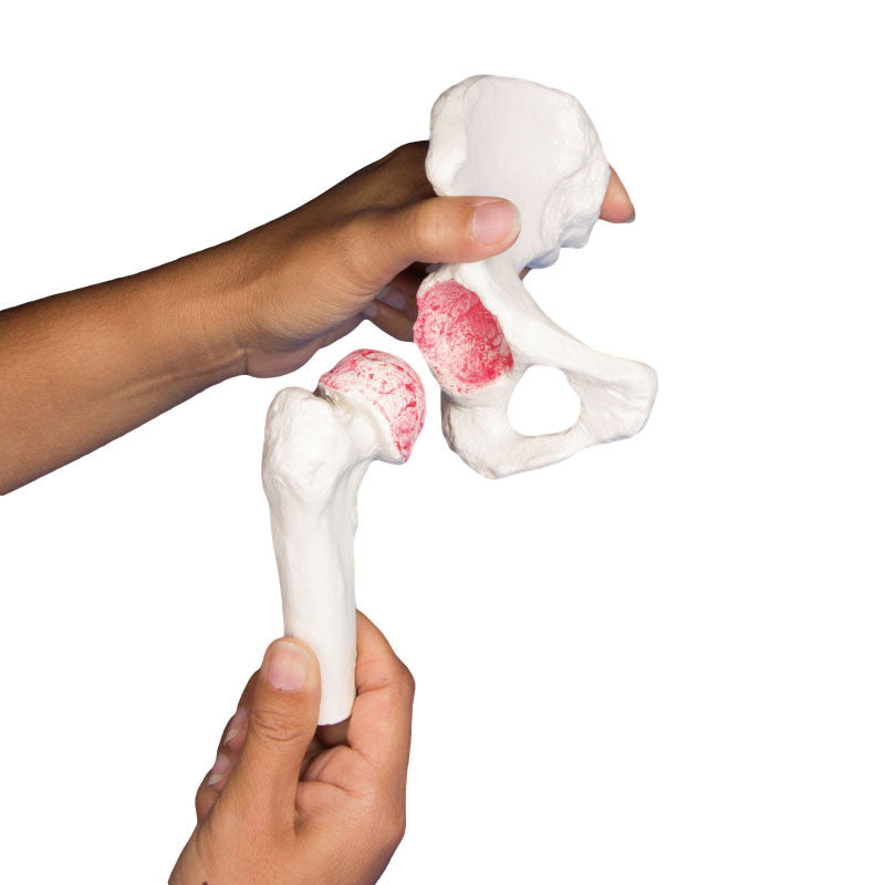 Hip Implant Comparison Set - magnetic articulation