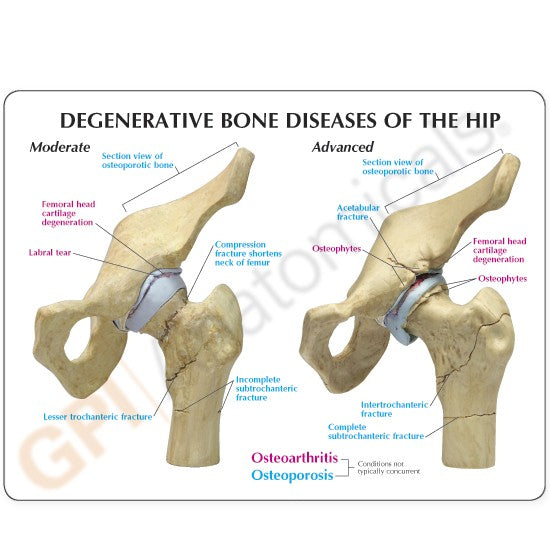 4-Stage Degenerative Hip Set