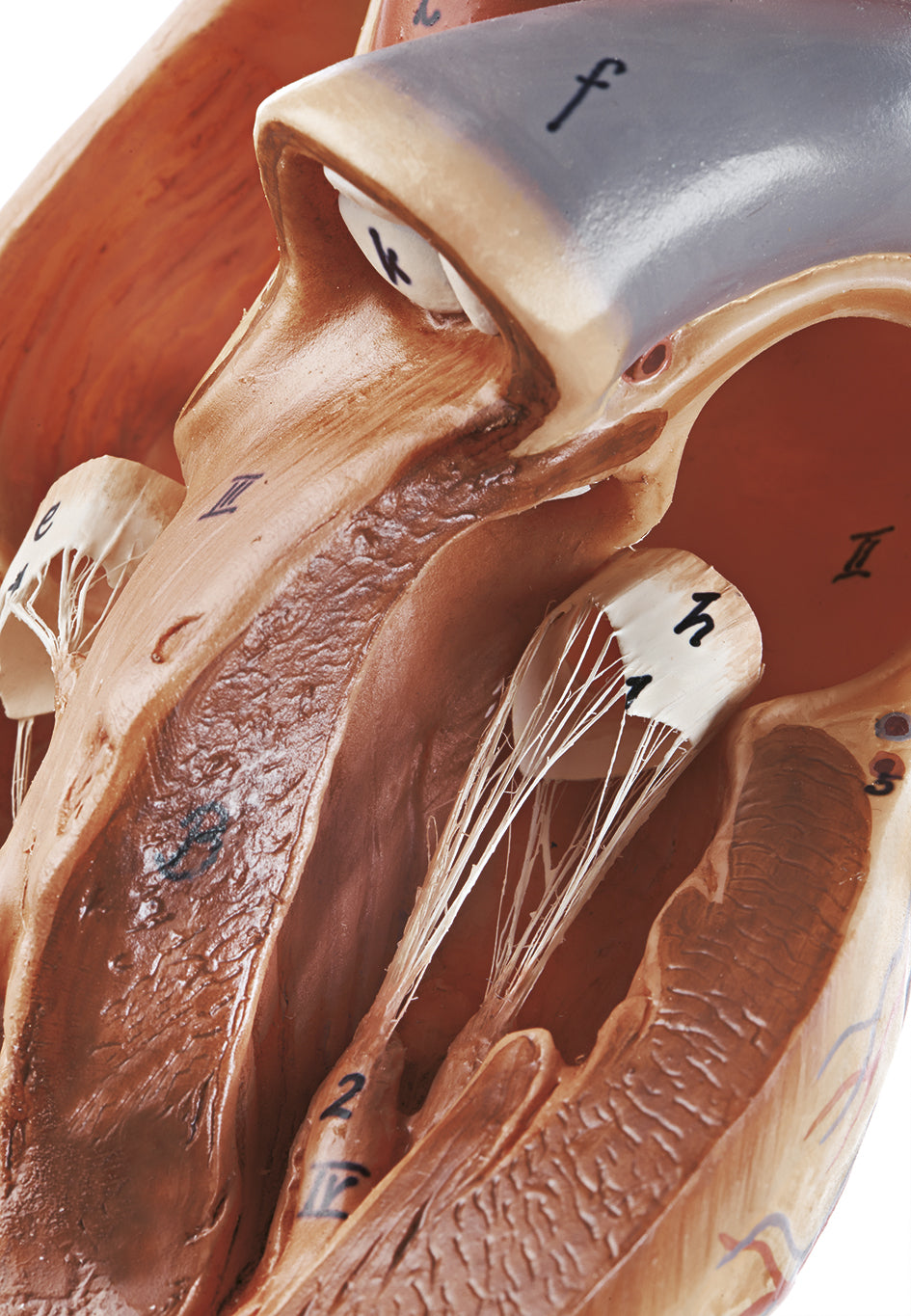 Model of the Heart with Bypass Vessels (Aortic Coronary Venous Bypass)