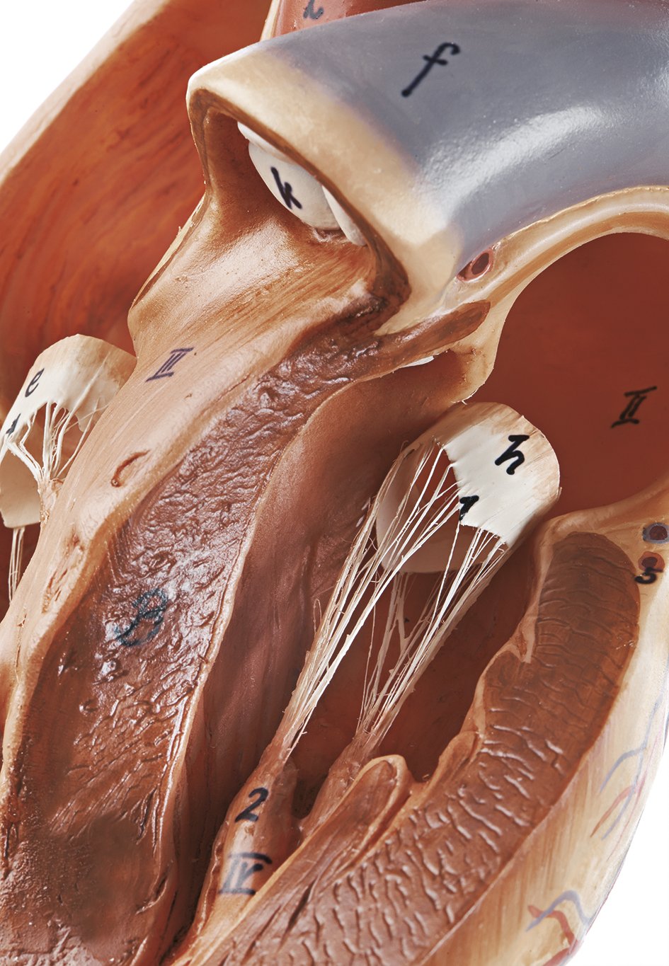 Model of the Heart with Bypass Vessels (Aortic Coronary Venous Bypass)