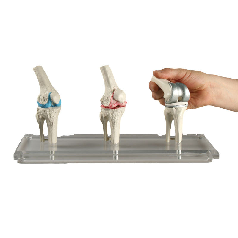 Knee Replacement Model Set moveable
