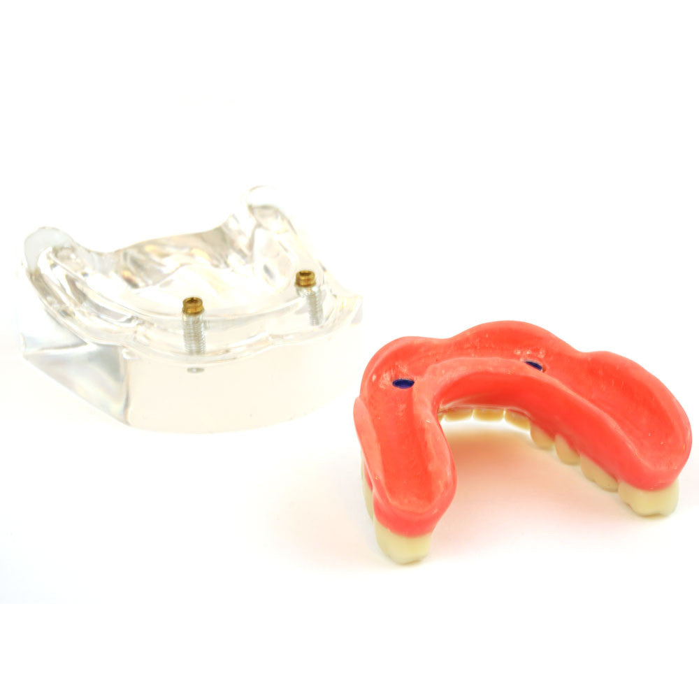 Lower denture model on 2 locator attachments