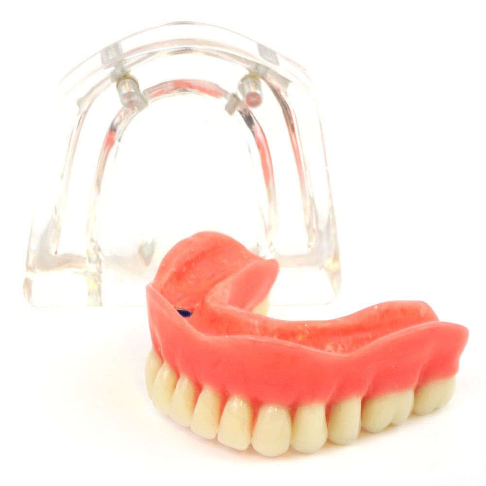 Lower denture model on 2 locator attachments