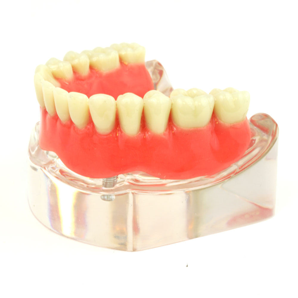 Lower denture model on 2 locator attachments
