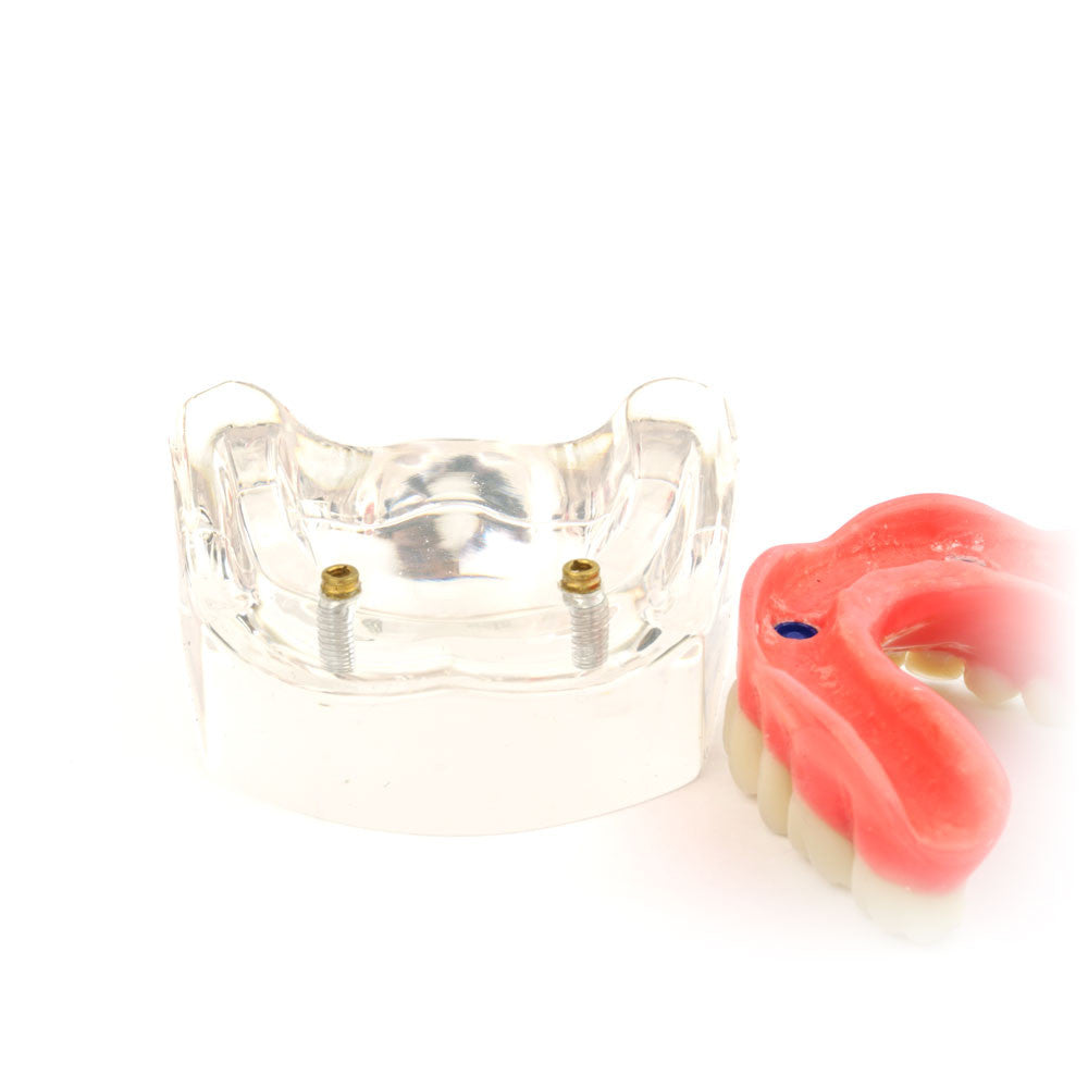 Overdenture model using 2 implant locators on a lower arch
