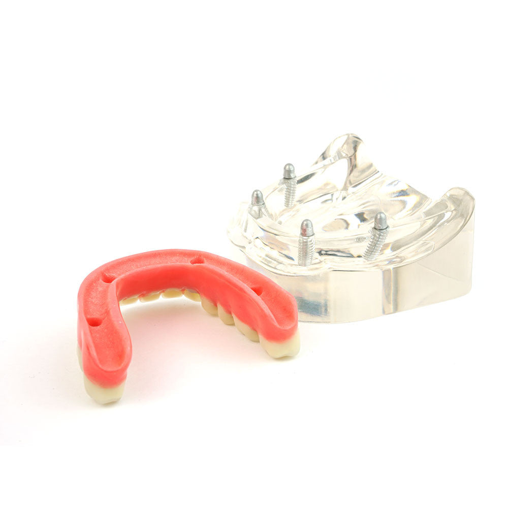 Lower denture model on 4 "pin style" abutments