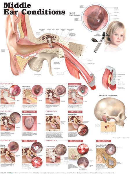 middle-ear-cond-2e-1_2__44236.1589753213.1280.1280.jpg