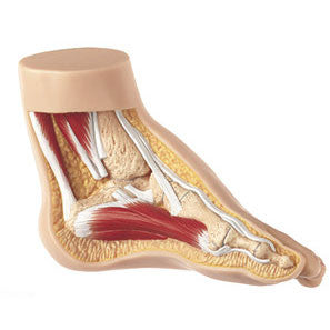 Club Foot Somso Ns 4