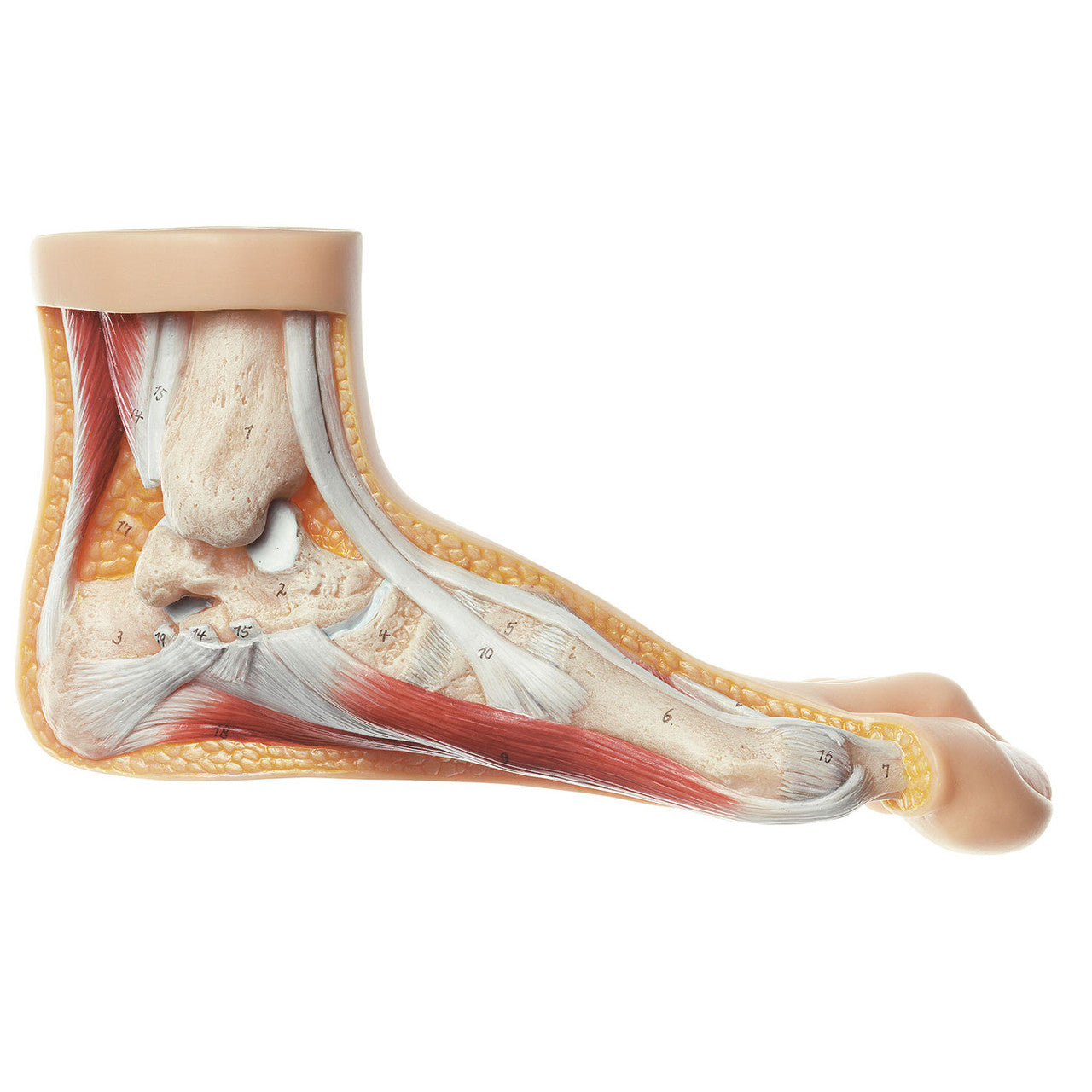Hallux valgus model Somso Ns 5