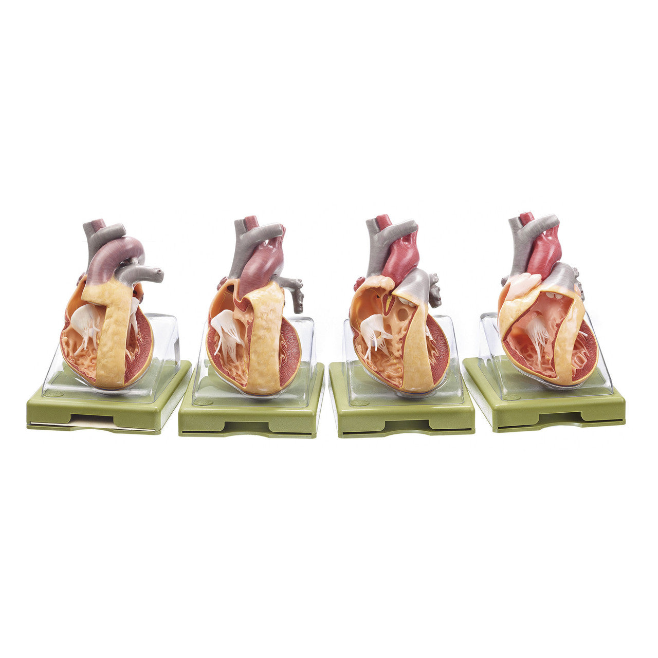 Series of Models Representing Congenital Organic Heart Diseases Somso Os 7