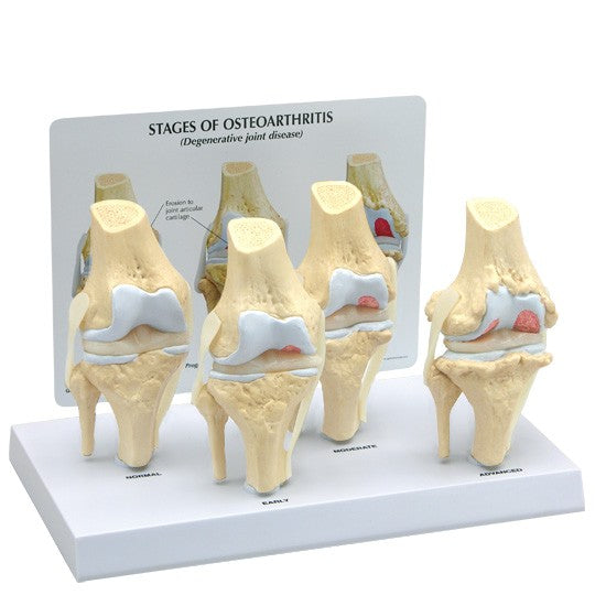 4-Stage Osteoarthritis Knee Set