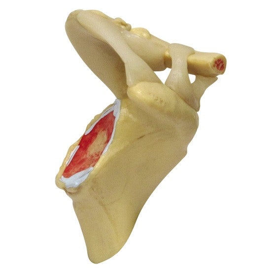 4-Stage Shoulder (Osteoarthritis)