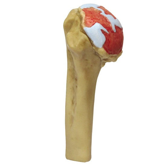 4-Stage Shoulder (Osteoarthritis)