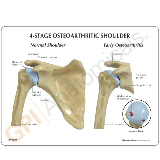 4-Stage Shoulder (Osteoarthritis)
