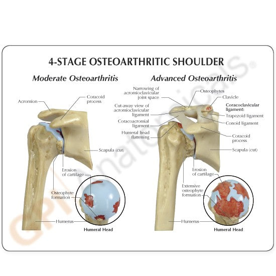 4-Stage Shoulder (Osteoarthritis)