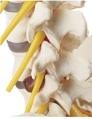 Vertebral Column with Pelvis with prolapsed disc