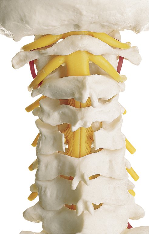 Vertebral Column with Pelvis with prolapsed disc