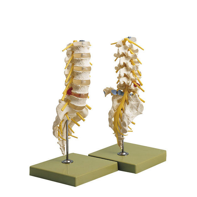 Lumbar Vertebral Column shows spondylolisthesis Somso Qs 66/1