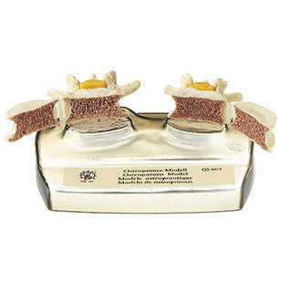 Osteoporosis Model Somso Qs 66/4