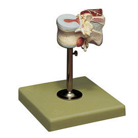 First Lumbar Vertebra with Herniated Discs and Dorsal Muscles Somso Qs 68/1