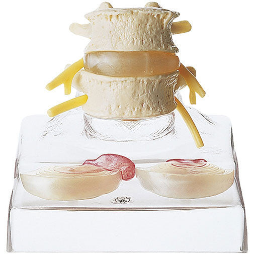 Central and Dorsolateral Herniated Disc Somso Qs 68/3