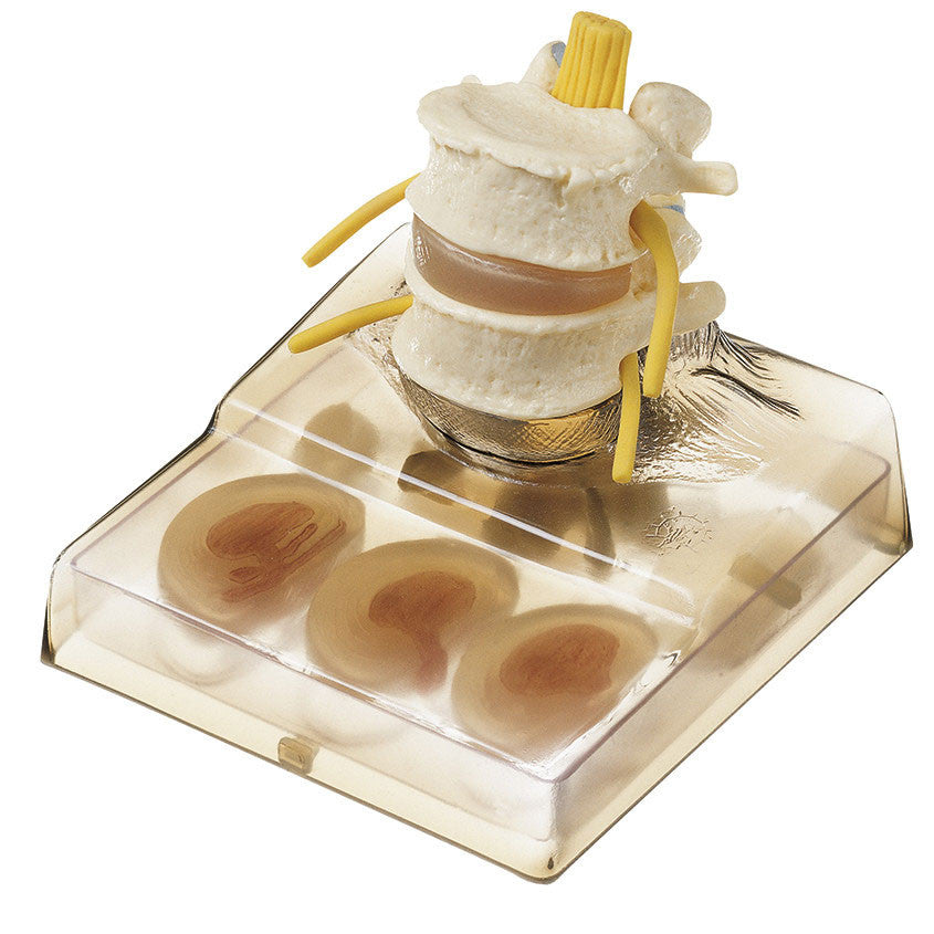 Intervertebral Disc Model Somso Qs 68/8