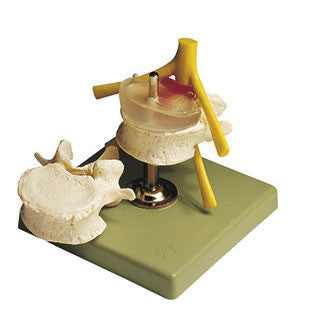 Hernia of Central Intervertebral Disc Somso Qs 68