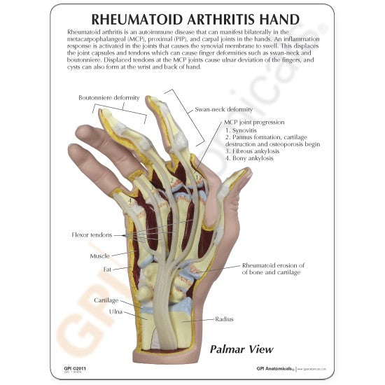 Rheumatoidarthritis (RA) Hand