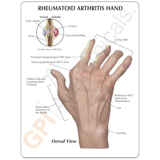 Rheumatoidarthritis (RA) Hand