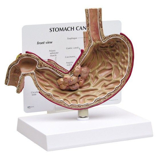 stomach-cancer-model-1-550x550__36322.1643511676.1280.1280.jpg
