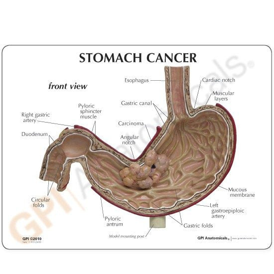 stomach-cancer-model-2-550x550__23454.1643511676.1280.1280.jpg