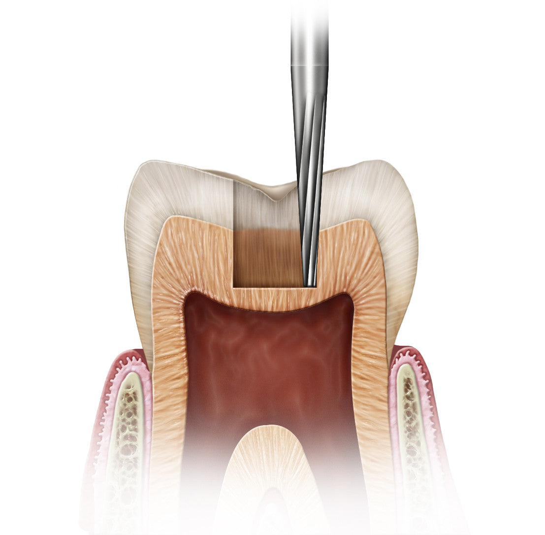 tapered_fissure_no_crosscuts__12924.1674111582.1280.1280.jpg