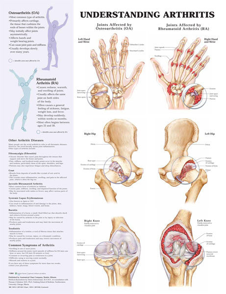 understanding-arthritis_1__31138.1589752976.1280.1280.jpg