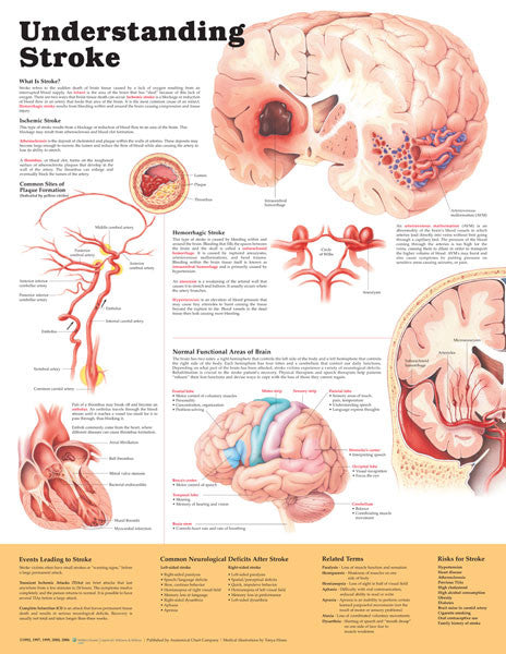 undestanding-stroke-title-r_1__51098.1589752911.1280.1280.jpg