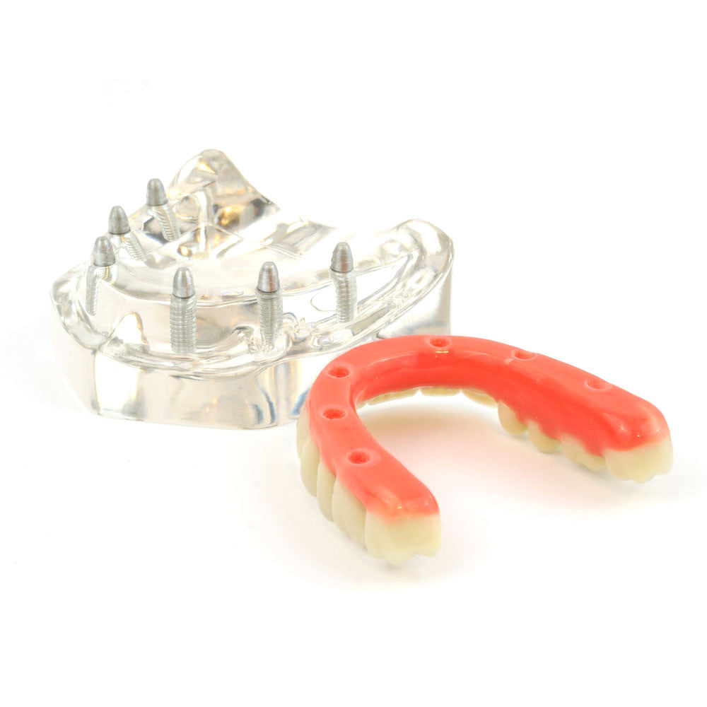 Upper denture model on 6 pin style abutments