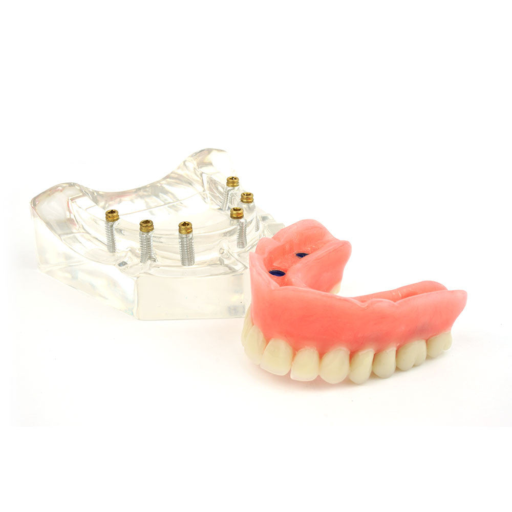 Upper denture model on 6 locator attachments
