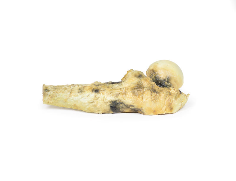 Osteosarcoma of femur