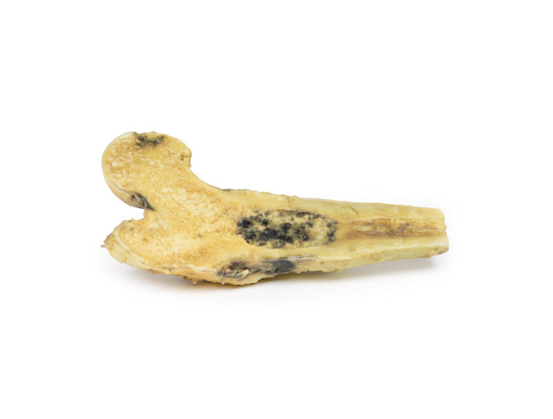Osteosarcoma of femur