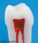 Composite Resin Teeth with Hollow Pulp