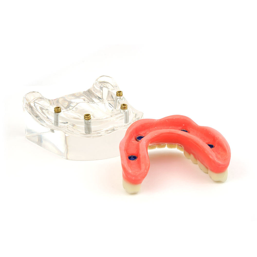Overdenture model using 4 implant locators on an lower arch