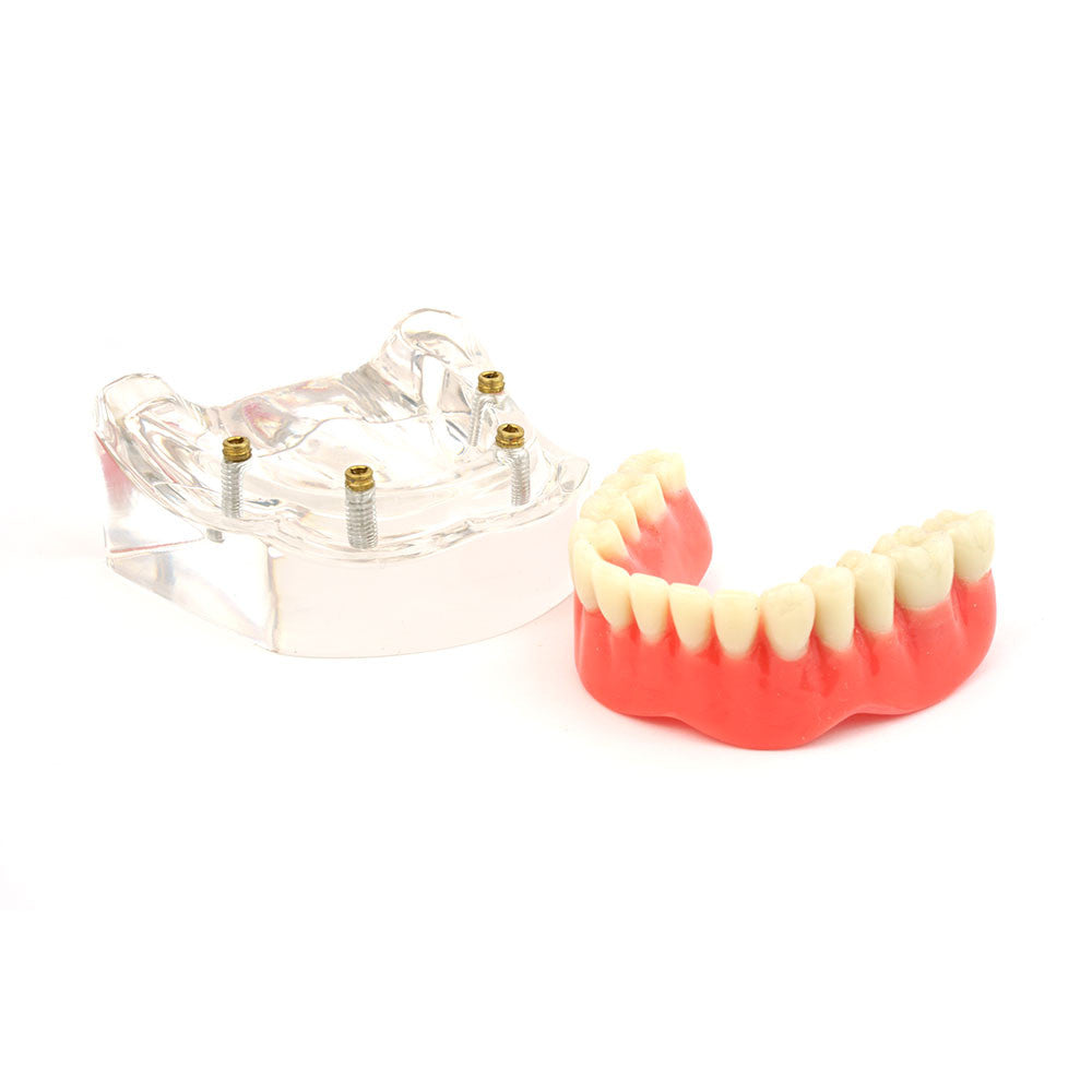 Overdenture model using 4 implant locators on an lower arch