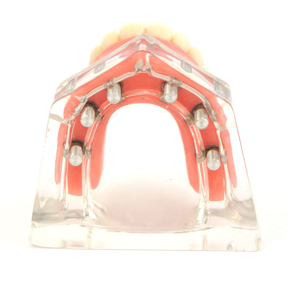 Overdenture model using 6 implant locators on an upper arch