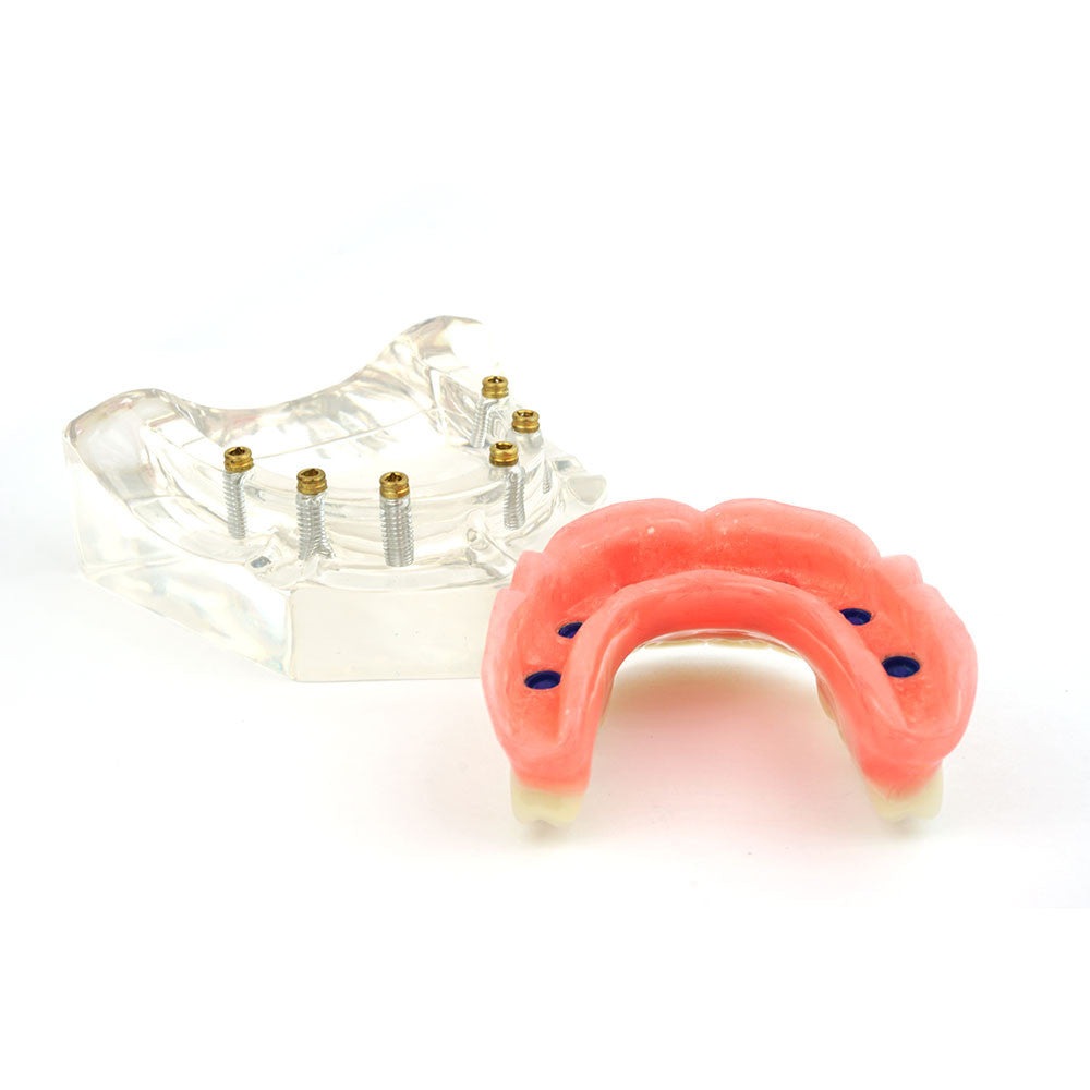 Overdenture model using 6 implant locators on an upper arch